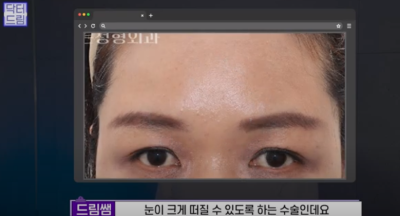 [강남역 성형외과] 깊어져만 가는 이마주름이 고민이라면 이것을 하세요 사진 28