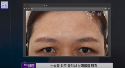 [강남역 성형외과] 깊어져만 가는 이마주름이 고민이라면 이것을 하세요 사진 27