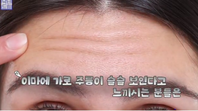 [강남역 성형외과] 깊어져만 가는 이마주름이 고민이라면 이것을 하세요 사진 2