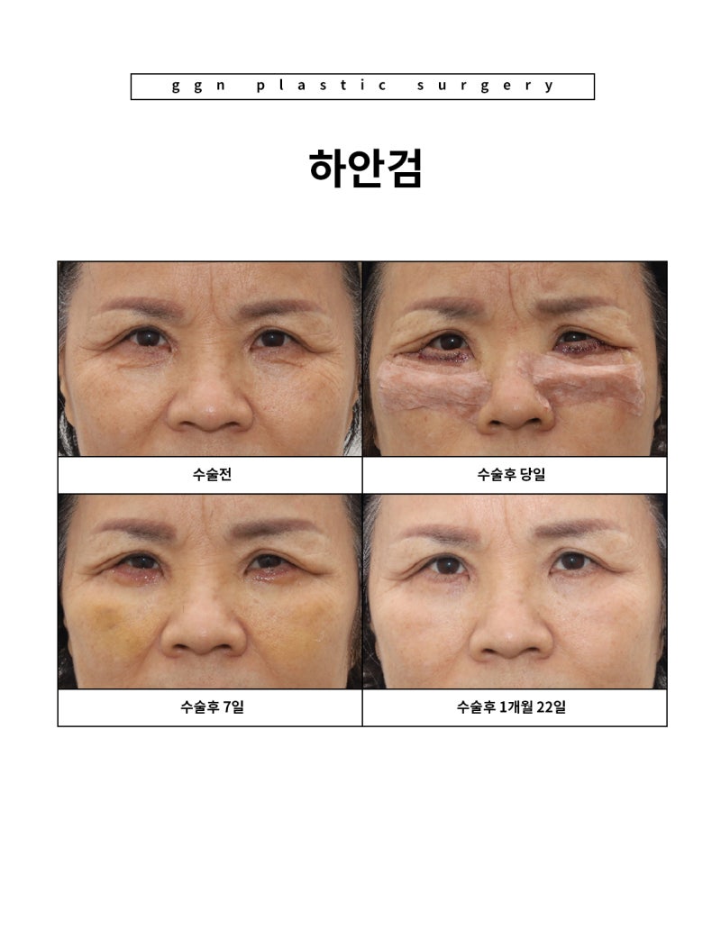 [강남역성형외과] "부모님 추석 선물 추천: 젊음을 되찾아 드리기" 사진 8