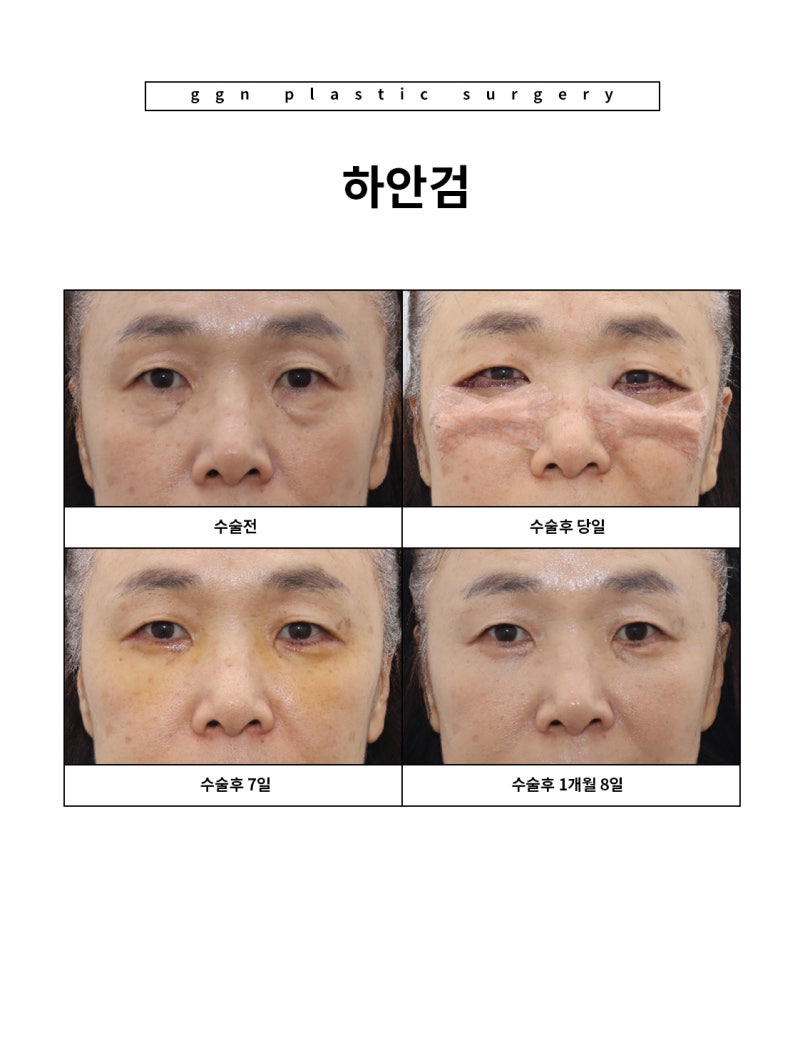 [강남역성형외과] "부모님 추석 선물 추천: 젊음을 되찾아 드리기" 사진 9