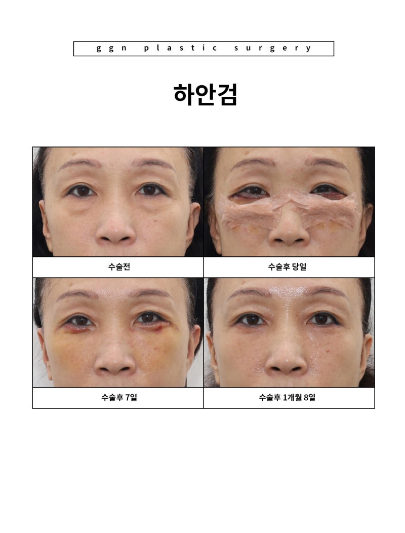[강남역성형외과] "부모님 추석 선물 추천: 젊음을 되찾아 드리기" 사진 7