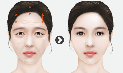 [강남역성형외과] 내려오는 이마, 처지는 눈이 고민이라면 : 내시경 이마거상술(엔도타인) 후기