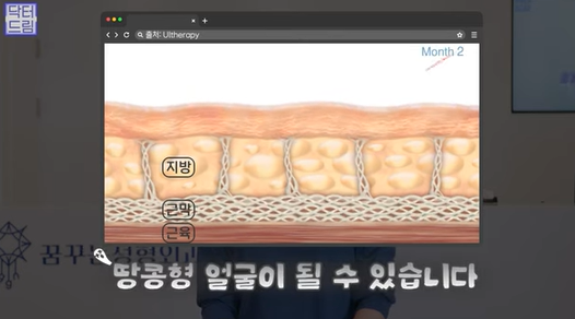 [강남역 성형외과] 닥터드림이 알려주는 내 얼굴에 딱 맞는 레이저 고르기 /레이저 오래가는 법 사진 10
