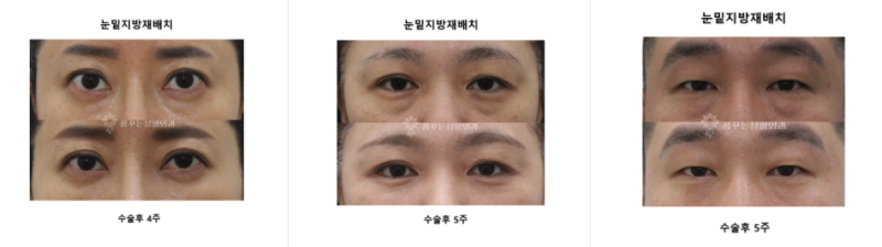 [강남역성형외과] 눈밑 꺼짐으로 다크써클, 얼굴이 어두워 보인다면? 사진 5