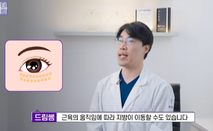 눈밑지방 없애러 왔는데 지방이식을 하라구요? 사진 29