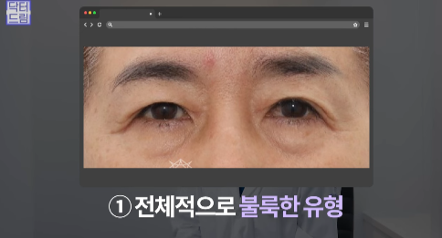 눈밑지방 없애러 왔는데 지방이식을 하라구요? 사진 6