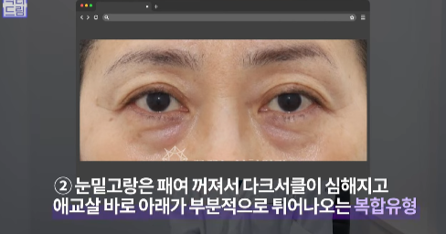 눈밑지방 없애러 왔는데 지방이식을 하라구요? 사진 7