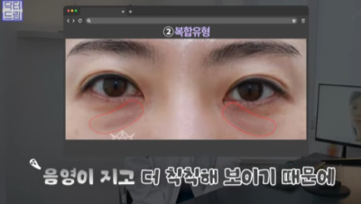 눈밑지방 없애러 왔는데 지방이식을 하라구요? 사진 11