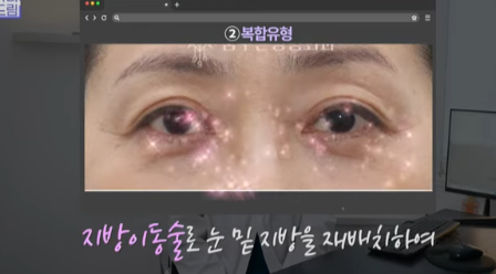 눈밑지방 없애러 왔는데 지방이식을 하라구요? 사진 10