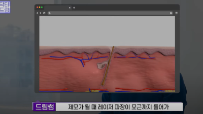 안아프고 하자마자 이뻐지는 티타늄레이저, 나만 아픈 이유? 작용원리 알아보기 사진 5