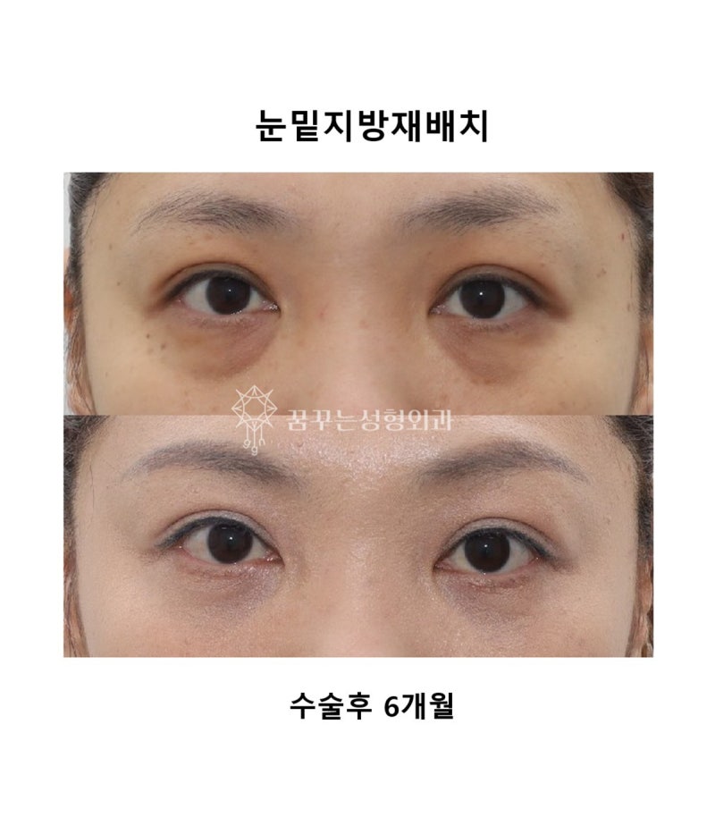 눈 밑 고랑이 꺼져서 다크서클이 심해 보인다면? 눈밑 지방 재배치 수술 추천! 사진 5
