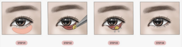 눈 밑 고랑이 꺼져서 다크서클이 심해 보인다면? 눈밑 지방 재배치 수술 추천! 사진 2