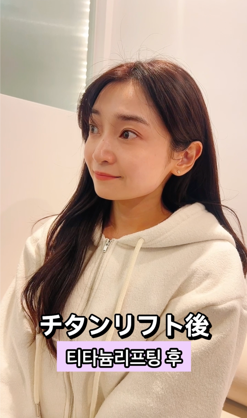 [강남역 리프팅레이져] 한국에서 티타늄 레이저와 보톡스로 작은 얼굴 만들기! 사진 8