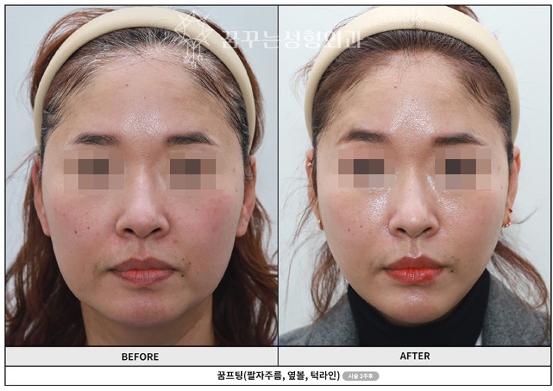 강남역 성형외과, 5군데 돌아보고 결국 정착하시는 이유? 사진 7