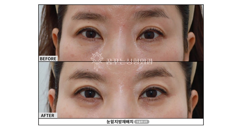 신논현 성형외과? 안티에이징 수술 전 이 3가지는 꼭 확인하세요