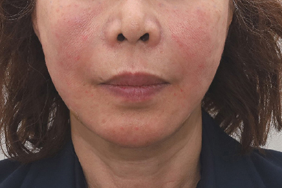 신논현 성형외과 팔자주름 실리프팅? 실패하지 않으려면 이것만 보고 가세요. 사진 2