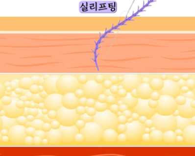 강남역 실리프팅 받기 좋은 나이? 저는 이렇게 답변 드립니다. 사진 3