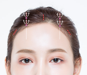 내시경이마거상, 받고 나서 후회하지 않으려면 살펴야 하는 것 사진 5