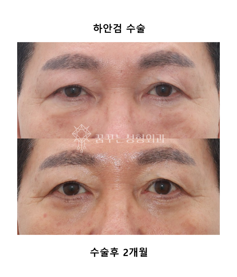 강남하안검수술 vs 눈밑지방재배치, 차이점 알고 계신가요? 사진 6