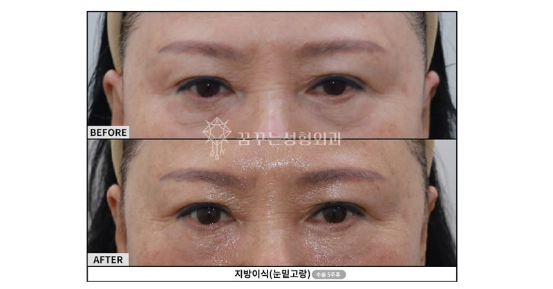 강남눈밑지? 다크서클 확실하게 없애는 핵심은 ‘이것’ 입니다. 사진 4
