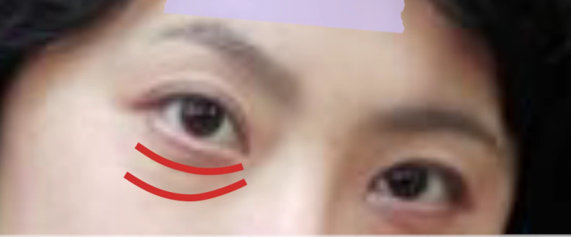 강남 하안검, 대표 원장이 가장 자주 듣는 질문 5가지 사진 5