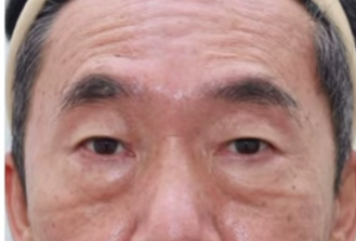 강남 하안검, 대표 원장이 가장 자주 듣는 질문 5가지 사진 10