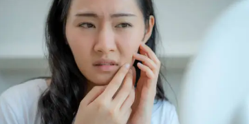 강남역 팔자주름 실리프팅 효과와 유지 기간 사진 4
