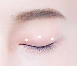 자연스러운 쌍꺼풀을 원한다면? 강남역 자연유착 쌍꺼풀 수술!