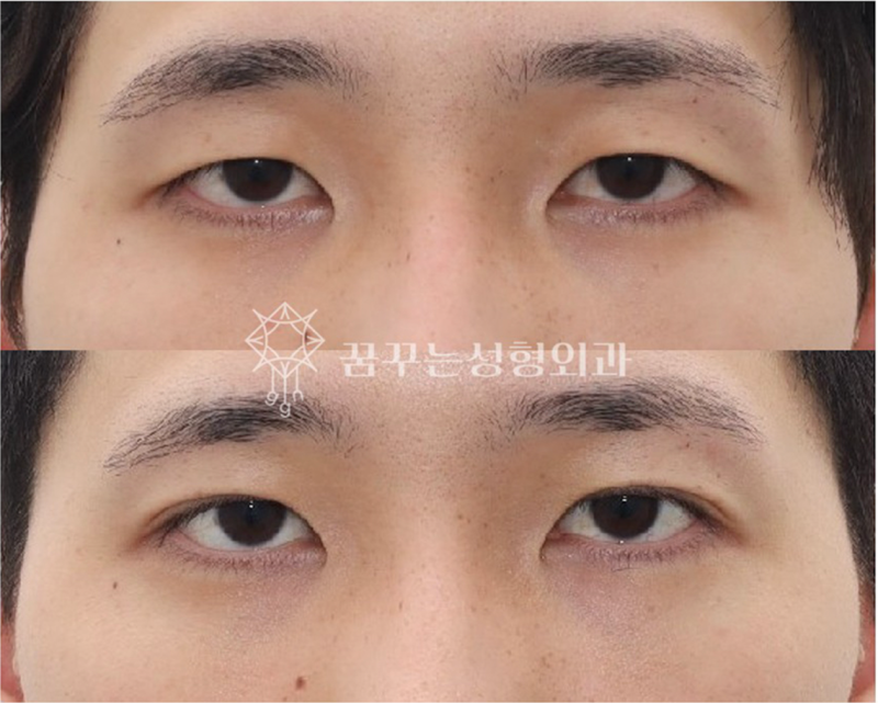 자연스러운 쌍꺼풀을 원한다면? 강남역 자연유착 쌍꺼풀 수술! 사진 8