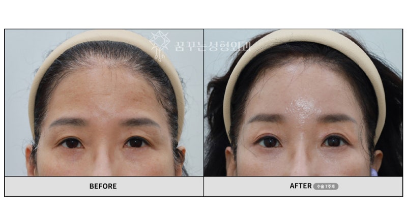 눈과 눈썹 사이가 가까우면 생기는 문제 – 해결법은? 내시경 이마 거상! 사진 7