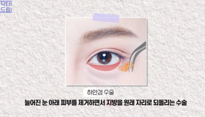 [닥터드림]눈밑지방재배치 하러왔다가 더 비싼 하안검한 사연 사진 16