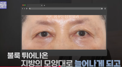 [닥터드림]눈밑지방재배치 하러왔다가 더 비싼 하안검한 사연 사진 14