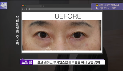 [닥터드림]눈밑지방재배치 하러왔다가 더 비싼 하안검한 사연 사진 21