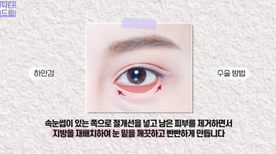 [닥터드림]눈밑지방재배치 하러왔다가 더 비싼 하안검한 사연