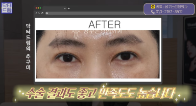 [닥터드림]눈밑지방재배치 하러왔다가 더 비싼 하안검한 사연 사진 24