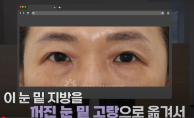 [닥터드림]눈밑지방재배치 하러왔다가 더 비싼 하안검한 사연 사진 3