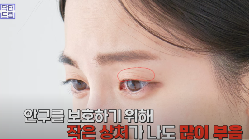 요즘 쌍꺼풀 안하는 상상초월 이유/ 쌍꺼풀 대신 이거합니다 사진 5