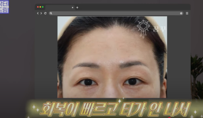 요즘 쌍꺼풀 안하는 상상초월 이유/ 쌍꺼풀 대신 이거합니다 사진 26