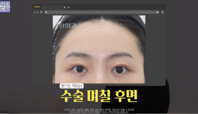 요즘 쌍꺼풀 안하는 상상초월 이유/ 쌍꺼풀 대신 이거합니다 사진 9