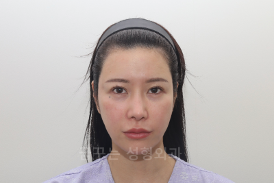 강남 이마거상 8일차 후기, 일본 모델 아야의 고민– 2-30대 이마주름 사진 4