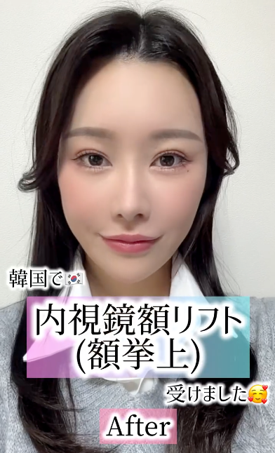 강남 이마거상 8일차 후기, 일본 모델 아야의 고민– 2-30대 이마주름 사진 2
