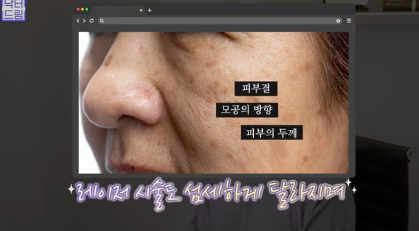 레이저 아플수록 효과가 좋을까요? 사진 8