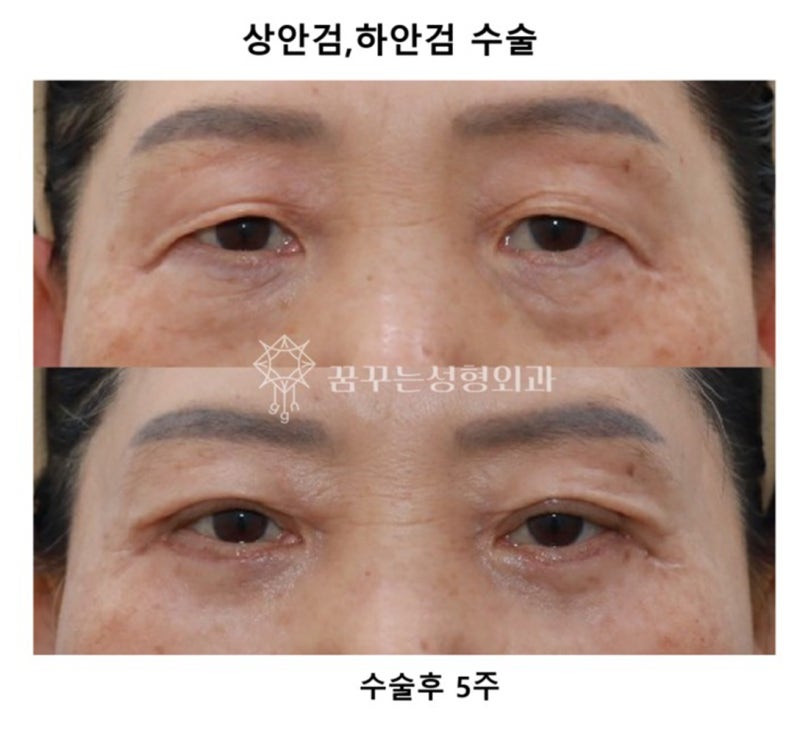 💐 5월 가정의 달, 부모님께 드리는 특별한 효도 선물– 이마거상 / 리프팅 / 상안검 / 하안검 / 눈밑지방재배치 추천 – 사진 5