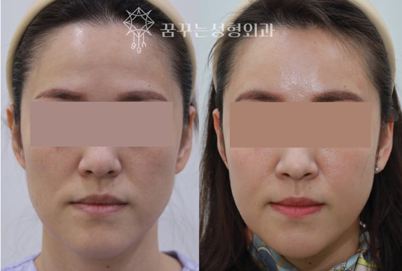 💡 지방이식과 필러, 어떤 차이가 있을까요? 강남역 성형외과 사진 2