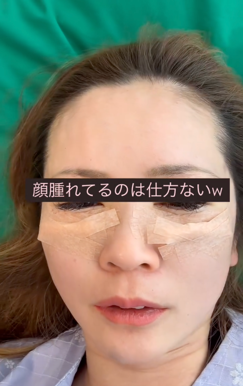 강남역 눈밑지방재배치 잘하는 곳 수술 후기✨ (꿈꾸는 성형외과) 사진 3