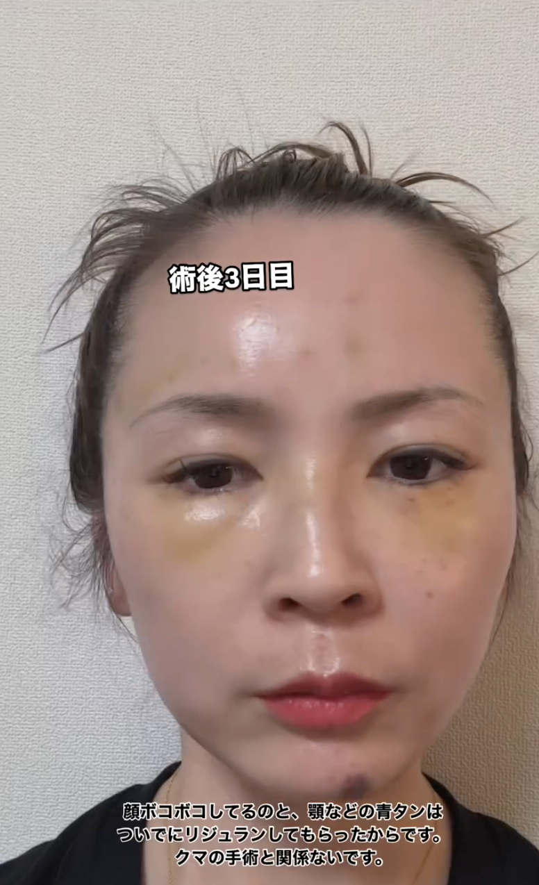 강남역 눈밑지방재배치 잘하는 곳 수술 후기✨ (꿈꾸는 성형외과) 사진 6