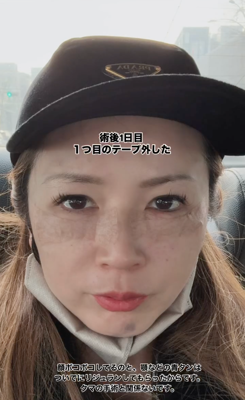 강남역 눈밑지방재배치 잘하는 곳 수술 후기✨ (꿈꾸는 성형외과) 사진 5