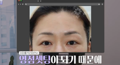 남편도 모르는 티안나는 극강의효과 동안성형 이마거상 사진 23