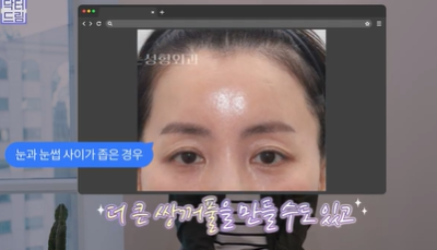 남편도 모르는 티안나는 극강의효과 동안성형 이마거상 사진 22
